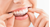 Vad är skillnaden mellan olika aligners – och varför vi väljer Invisalign